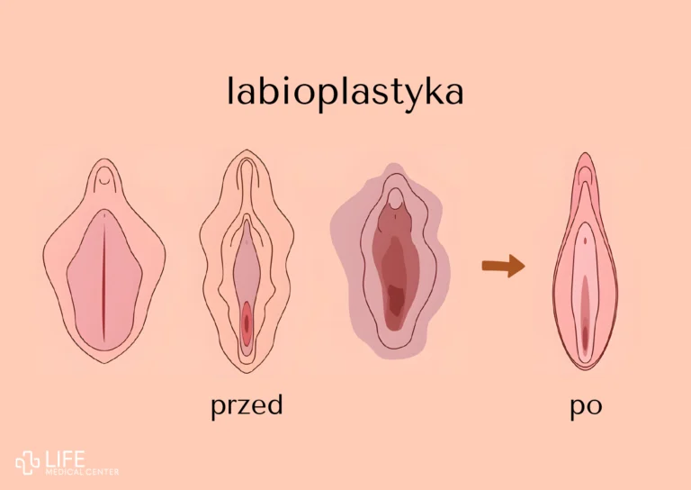 labioplastyka zabieg warszawa