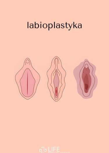 labioplastyka warszawa powody cena