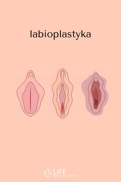 labioplastyka warszawa powody cena